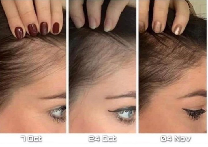 Foto prima e dopo la crescita dei capelli dopo l'applicazione del trattamento Nutriol e Galvanic Spa
